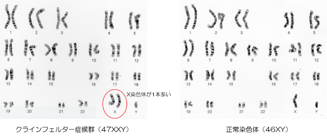 クラインフェルター症候群