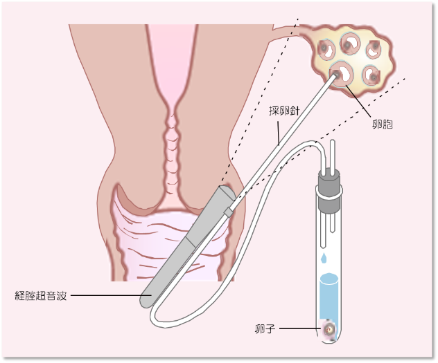 採卵の方法