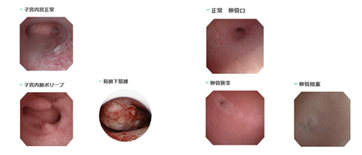 子宮鏡検査で観察される病態について