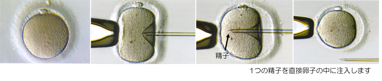 顕微授精の方法