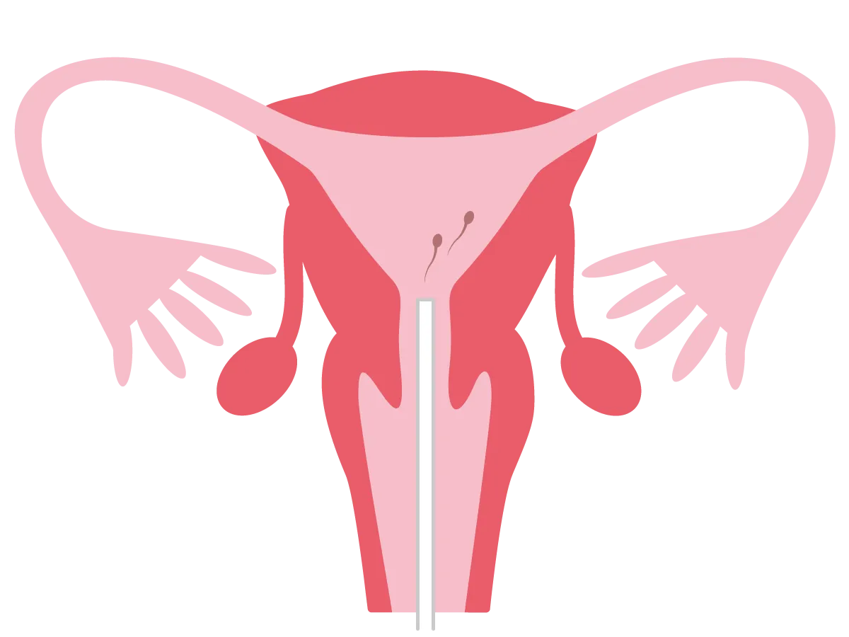 子宮内人工授精法（IUI）