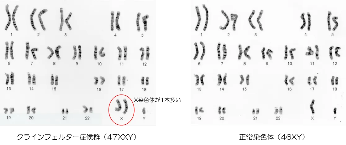クラインフェルター症候群