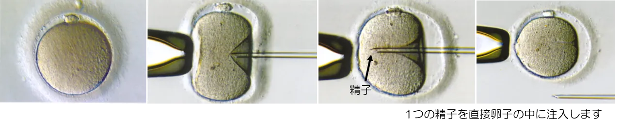 標準体外受精の方法